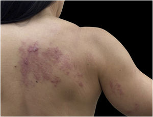 Herpes zoster: typical dermatomal involvement with erythema and vesicles.