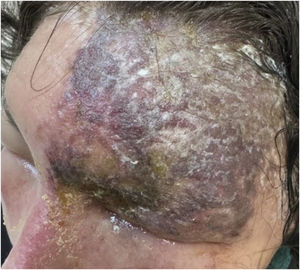 Extensive necrotic herpes zoster in an HIV-infected patient. Severe unilateral dermatomal involvement with extensive vesiculation and necrotic changes. Courtesy: Hiram Larangeira de Almeida Jr., MD, PhD.