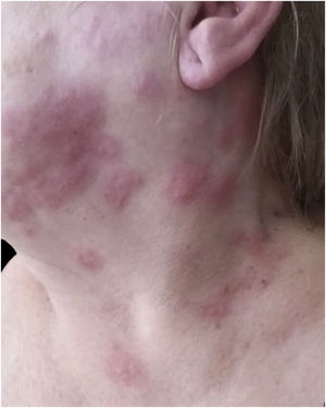 Cervical herpes zoster. Grouped vesicles on an erythematous base were distributed unilaterally along a cervical dermatome, respecting the midline. Courtesy: Hiram Larangeira de Almeida Jr., MD, PhD.