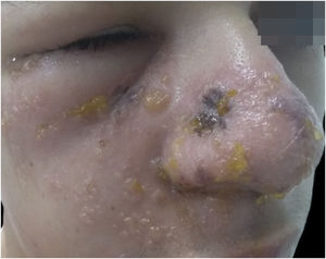Facial herpes zoster. Unilateral vesicular eruption involving the facial region, consistent with the trigeminal nerve distribution.