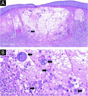 Skin histological section showing an intraepidermal vesicle with acantholysis, ballooning, and reticular degeneration in the epidermis. Note the multinucleated keratinocytes (arrow) and lymphocytic inflammatory infiltrate in the superficial dermis (Hematoxilyn & eosin, ×85) (A) Higher magnification demonstrating viral cytopathic changes. Multinucleated keratinocytes, nuclear molding, and peripheral chromatin margination (