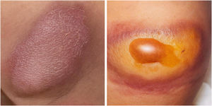 The image on the left shows the mastocytoma at birth. The image on the right shows the mastocytoma on the 9th day of life, with the appearance of blisters.