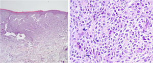 The image on the left shows monomorphic and fusiform round cells, diffusely arranged in the papillary and upper reticular dermis. On the right, at higher magnification, numerous mast cells ( Hematoxylin & eosin).
