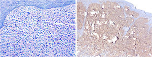 The image on the left shows mast cell proliferation using Giemsa staining. On the right, the CD117 (c-KIT) immunohistochemical reaction is diffusely positive in mast cells.