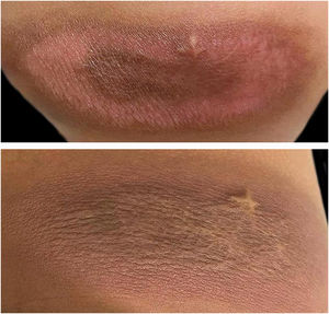 The lesion involution can be observed by comparing it at the age at nine months (left) and two years (right).