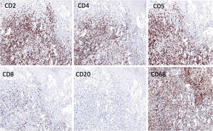 Immunohistochemistry strongly positive for CD2, CD4, CD5 and CD68, weaker staining for CD8 and negative for CD20 (×200).