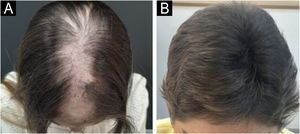 (A) Case 2. Photograph of a patient diagnosed with alopecia areata with a large alopecic patch in the frontal area, midline, parietal, temporal and occipital areas of the scalp, SALT index 46. (B) Same patient, after one month of discontinuation of therapy, after having received 16 sessions of excimer light with SALT 0.