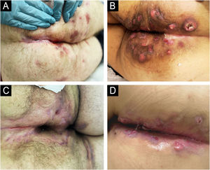 (A) Linear ulceration with surrounding inflammation in a patient with Hurley stage III HS and extensive gluteal involvement. (B) Nodular and abscessed lesions within the intergluteal cleft, consistent with severe inflammatory activity. (C) Fibrotic scarring and fissuring along the midline, suggestive of chronic disease and structural remodeling. (D) Superficial ulceration and papules confined to the intergluteal fold, in a patient without other follicular occlusion disorders.