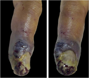 A purplish, ulcerated, friable, and vegetating nodule covered by fibrinous exudate in the periungual region.