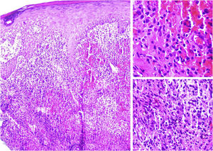 Epidermal hyperplasia and granulomatous infiltrate with neutrophils (left. Hematoxylin & eosin, ×4). Infiltrate of epithelioid cells (upper right. Hematoxylin & eosin, ×40). Neutrophil microabscess in the dermis (lower right. Hematoxylin & eosin, ×40).