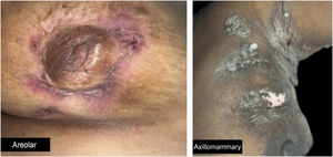 Areolar and axillomammary forms – subtypes of breast involvement by hidradenitis suppurativa to be considered in the classification.