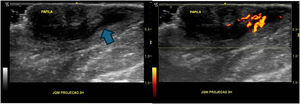 Ultrasound findings: Areolar HS – Fistula in the dermis/hypodermis at the junction of the medial quadrants of the right breast, periareolar, in a 3H projection with communication with a duct in the retroareolar region (blue arrow). Increased locoregional vascularization is noted on Doppler (Power) study.