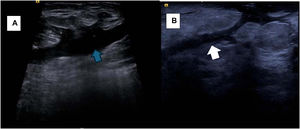 Ultrasound findings of idiopathic granulomatous mastitis – (A) Collection with anechoic content and some suspended debris (blue arrow), located in the inferolateral quadrant of the left breast; (B) Hypoechoic collection, located in the right breast, with a periareolar fistulous tract (white arrow).