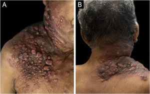 Infiltrated erythematous-violaceous plaque with a shiny surface extending from the mandibular region to the anterior and posterior right thorax.