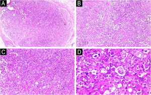 Histopathological characteristics. (A) Intradermal neoplasm with expansive growth, without connection to the epidermis and located mainly in the dermis. (B-C) Malignant epithelioid neoplasm, with intense, predominantly lymphocytic inflammatory infiltrate. (D) Malignant epithelial cells with pleomorphic nuclei, evident nucleoli and atypical mitoses (Hematoxylin & eosin; A: ×40, B–C: ×100, D: ×400).