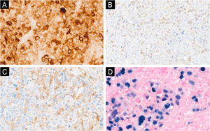 Immuno-histochemical analysis demonstrating positivity for EMA (A, ×400), p40 (B, ×400), CD45 (C, ×400) and EBER in situ hybridization (D, ×400).