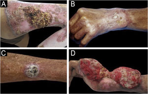 Clinical characteristics of tumoral neoformations arising on CBM scars. (A) Exophytic, vegetating tumoral lesion with areas of ulceration and bleeding over the scar. (B) Exophytic, keratotic lesion with ulcerated areas; note the exposure of ligaments. (C) Keratotic nodular lesion on an erythematous base. (D) Elevated plaque-like neoformation with denuded and bleeding areas, painful, over the scar, all confirmed as squamous cell carcinoma.