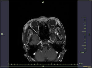 Enhanced MRI (pretreatment): The subcutaneous soft tissues of the frontotemporal region and periorbital area demonstrate thickening, with a maximum thickness of approximately 1.5 cm. Patchy foci of isointense T1 and slightly hyperintense T2 signals are identified, showing ill-defined margins and heterogeneous signal intensity. Post-contrast imaging reveals homogeneous enhancement of these lesions; on T2WI sequences, interspersed areas of hyperintense T2 signals are noted within the lesions, which also exhibit homogeneous enhancement following contrast administration.
