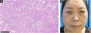 (A) Pathological picture, Hematoxilyn & eosin 4× magnification (pretreatment): Area of suspected cystic foreign body deposition, surrounded by a large number of epithelioid histiocytes and multinucleated giant cells. Some granulomas show nodular and diffuse distribution. Diffuse inflammatory cell infiltration (predominantly lymphocytes and plasma cells) is seen around the granulomatous nodules and in the stroma. (B) 3-weeks after treatment.