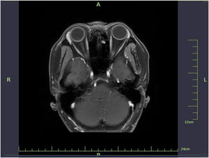 Enhanced MRI (3-weeks after treatment): The frontal soft tissues show slight swelling with heterogeneous slightly prolonged T1 and slightly prolonged T2 signals and ill-defined margins, with moderate enhancement noted on post-contrast imaging. Focal small patchy areas of slightly hyperintense DWI signals are seen in the local soft tissues. The frontal bone demonstrates linear patchy hyperintense DWI signals with insignificant changes in T2 and T1 signals; post-contrast enhancement is not well-defined, with suspected mild enhancement.