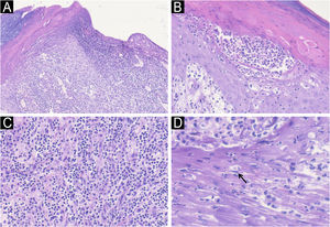 Light microscopy. (A) Central area of ulceration covered by a scale-crust. (B) Neutrophils microabcess. (C) Dense dermal infiltrate (D) Eosinophilic inclusion body (arrow). (Hematoxylin & eosin, ×100, ×400, ×400, ×500).