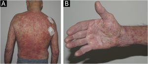 (A) Well-demarcated erythematous plaques with overlying pustules affecting the back and upper limbs (abdomen and lower limbs not shown). (B) Coalescing pustules over the bilateral palmar surfaces.