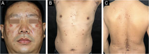 The skin lesions of Case 1 manifest as multiple dark red papules, nodules, and plaques on the face (A) with clear borders and mild infiltration, scattered brownish round patches on the trunk, and characteristic dorsal dark brown patches mainly on the axillae (B) and along the midspinal line (C).