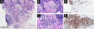 (A‒B) Skin biopsy shows intensive plasma cell infiltration in the whole layers of the dermis (A, Hematoxylin & eosin, ×40) and around vessels, appendages, and collagens (B, Hematoxylin & eosin, ×100). (C) Extensive perivascular plasma cell infiltration (Hematoxylin & eosin, ×400). (D‒E) Skin-infiltrating plasma cells show positive CD138 immunohistochemical staining (D ×40; E ×200).