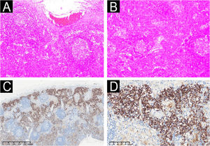 (A‒B) Histopathology of lymph nodes shows proliferation of lymphoid tissue, partial atrophy of lymphoid follicles, and considerable morphologically mature plasma cell infiltration between the follicles (Hematoxylin & eosin, ×100). (C‒D) CD138 immunohistochemical staining shows dense infiltration of CD138-positive plasma cells within lymphoid follicles (C ×40; D ×200).