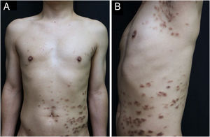 Multiple dark brown patches, papules, and nodules in the lumbar region and axillae (A‒B).