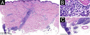 (A‒C) Histopathology shows dense infiltration of lymphocytes, plasma cells, and histiocytes in the dermal vasculature and the periphery of the small nerves and appendages (A, Hematoxylin & eosin, ×40; B, Hematoxylin & eosin, ×400; C, Hematoxylin & eosin, ×100).