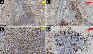Skin lesion immunohistochemistry of case 2 showed IgG(+) and IgG4(+) plasma cell infiltration: (A, C) IgG + plasma cells (immunohistochemical staining for IgG, A ×100, C ×400). (B, D) IgG4+ plasma cells (immunohistochemical staining for IgG4, B ×100, D ×400).