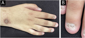 (A) Spontaneous ulcer on the right arm, with total onychodystrophy of fingernails. (B) Magnification of nail onychodistrophy of the fourth finger, showing complete dystrophy of the nail plate.