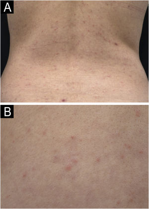 Maculopapular rash following dengue vaccination with Butantan-DV. (A) Erythematous papules and macules on the lumbar region. (B) Close-up of the non-follicular papules and macules on the abdomen.