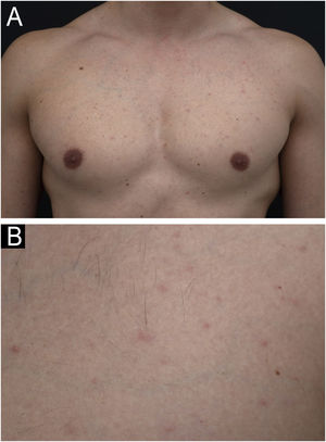 Maculopapular rash following dengue vaccination with Butantan-DV. (A) Erythematous papules and macules on the chest, epigastrium, and upper arms. (B) Close-up of the non-follicular papules and macules on the chest.