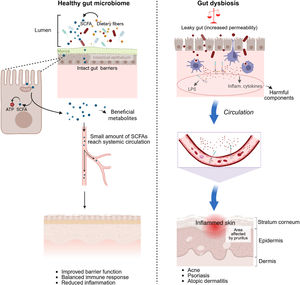 The gut-skin axis and systemic health. Comparative overview of a healthy gut microbiome, which produces beneficial metabolites such as SCFAs that support skin barrier function, versus gut dysbiosis. In gut dysbiosis, a “leaky gut” allows translocation of LPS and inflammatory cytokines into circulation, worsening inflammatory skin conditions such as acne and psoriasis. Created in https://BioRender.com.