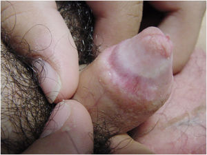 Sclerosis and atrophy of the entire glans, with telangiectasias, stenosis of the urethral meatus, and complete obliteration of the balanopreputial sulcus.