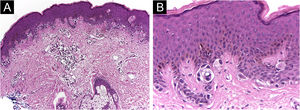 Junctional dysplastic melanocytic nevus with marked cytoarchitectural disorder. Hematoxylin & eosin, ×40 (A) and ×400 (B).