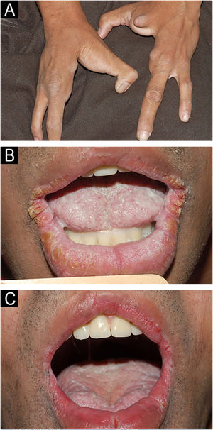 (A) Oligodactyly; (B) WSN: thickening of the lingual mucosa; keratosis and fissures on the commissures and on the lower lip vermilion; (C) Excellent result with cryotherapy; this picture was taken several years after treatment.