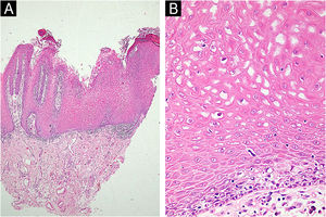 Histopathology of WSN. (A) Acanthosis, papillomatosis, clear spaces in the mucosal epithelium; (B) Cytoplasmatic clearing and eosinophilic perinuclear condensations of the mucosal keratinocytes (Hematoxylin & eosin, A‒100×, B‒400×).