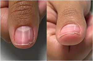 Longitudinal leukonychia extending to the lunula, V-shaped onycholysis, and a distal fissure.