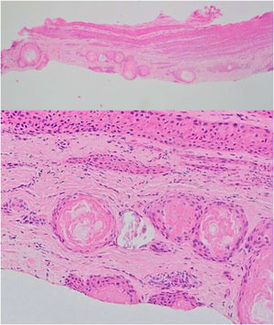 Nail bed epithelium with mild acanthosis, multiple small onycholemmal cysts in the dermis.