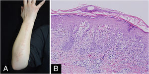 Lichen striatus -like lesions developed following IL-23 inhibitor treatment. (A) Clinical manifestations and (B) Histopathological examinations lichen striatus -like lesions of the psoriasis patient after 4-months guselkumab treatment (Hematoxylin & eosin, ×100).