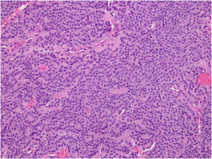 Hematoxylin & eosin (400×). Proliferation of monomorphic glomus cells with round nuclei and eosinophilic cytoplasm, arranged in nests and sheets around thin-walled blood vessels.