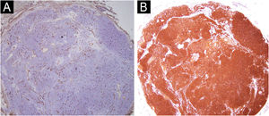 Immunohistochemistry. (A) CD34, negative staining in lesional cells (20×). (B) Positive smooth muscle actin in lesional cells (20×).