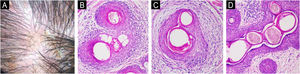 This figure presents a clinical picture and photomicrographs of patients from the seborrheic dermatitis group. (A) Trichoscopic view of Patient 32 showing perifollicular and interfollicular yellowish-white scales. (B) Transverse histological section from Patient 32 depicting the isthmus area of a follicle surrounded by lymphocytic inflammation, with epithelial spongiosis, vacuolar interface change, and lymphocyte exocytosis (Hematoxylin & eosin, 200x). (C) Patient 53 showing prominent perifollicular fibrosis, blurred interface, and lymphocytic infiltration in the follicular epithelium (Hematoxylin & eosin, 200x). (D) Histological section from Patient 30 showing multiple hair shafts in a common follicular canal (polytrichia) (Hematoxylin & eosin, 200x).