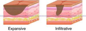 Comparative illustration representing tumor growth and infiltration patterns used in the classification of each type of invasion front, considering similar Breslow thickness (blue line).