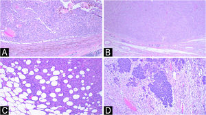Visual representation of examples of “expansive” and “infiltrative” invasion fronts; (A and B) two examples of an expansive invasion front pattern in which the deeper edge of the lesion is more organized and well-defined, with “crescent-shaped” growth (Hematoxylin & eosin; ×40); (C and D) two examples of infiltrative invasion front patterns where the deepest portion of the lesion presents more irregularly, infiltrating the adipose tissue in a "honeycomb"-like pattern (image C, Hematoxylin & eosin ×40) or with an invasion front exhibiting acute-angle /triangular growth (image D, Hematoxylin & eosin, ×100).
