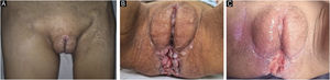 (A) Lymphedema of the right lower limb (June 2024). (B) Vegetative and ulcerated lesions in the perianal region and perineum (June 2024). (C) Regression of lesions after treatment (December 2024).
