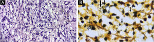 Microscopic examination showing inflammatory infiltrate of vacuolated histiocytes and lymphocytes. (A) Hematoxylin & eosin, ×400. (B) Warthin-Starry. Donovan bodies (arrows; ×1000).